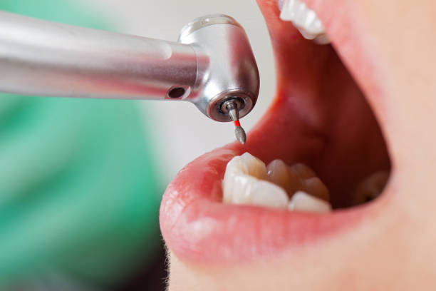 Best Emergency Tooth Extraction in Liberty, NC